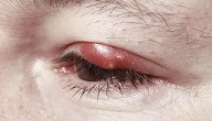 امراض العيون وعلاجها بالاعشاب