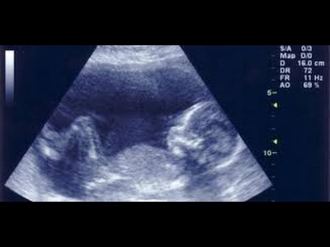معرفة نوع الجنين في الشهر الثالث