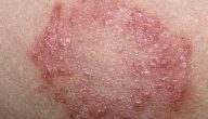 انواع امراض الجلد الفطرية