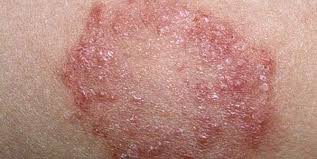 انواع امراض الجلد الفطرية