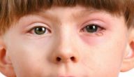 امراض العيون عند الاطفال بالصور