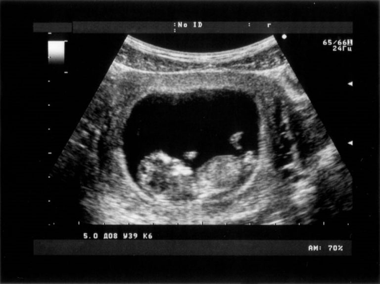 متى يظهر الجنين في كيس الحمل في اي اسبوع مفهرس