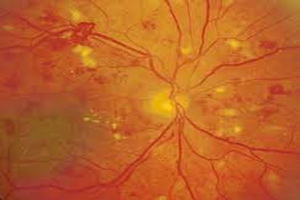 ما هي أمراض شبكية العين