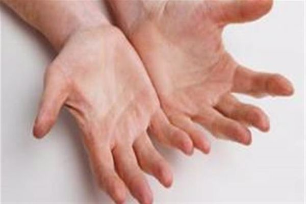 ما هو علاج روماتيزم اليدين