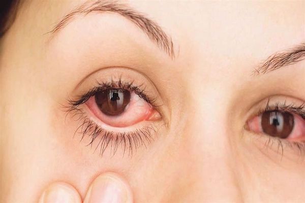 أمراض العين الفيروسية