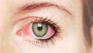 ما هي اعراض التهاب العصب البصري