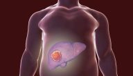 ما هي اعراض ورم سرطان الكبد