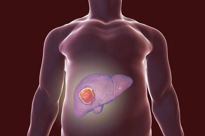 ما هي اعراض ورم سرطان الكبد