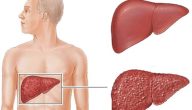 ما هو علاج غيبوبة الكبد