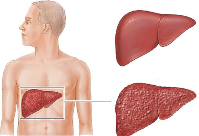 ما هو علاج غيبوبة الكبد