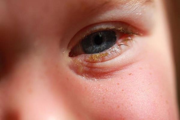 علاج التهاب العين بالشاي