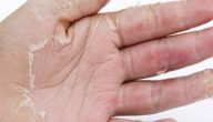 أسباب تقشير جلد اليدين عند الأطفال