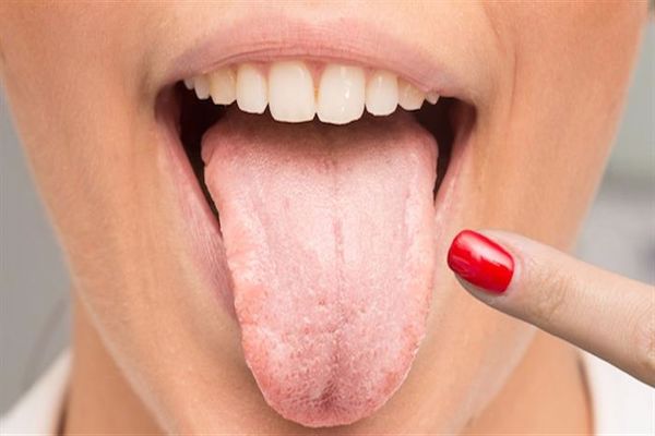 أعراض الكانديدا في الفم