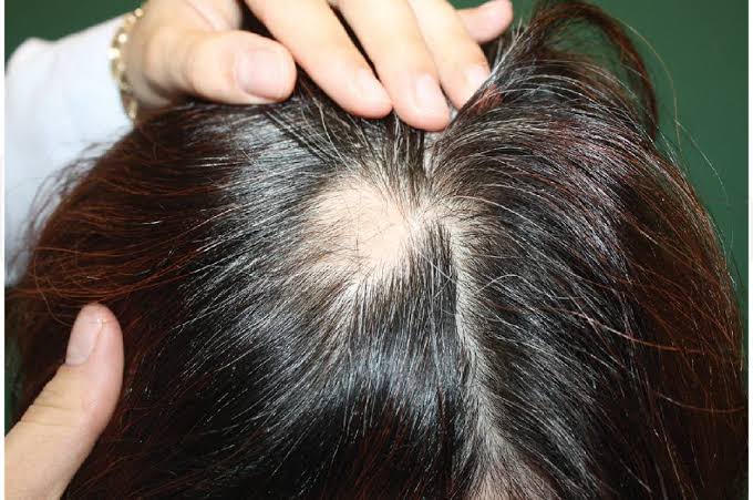 أعراض ثعلبة الشعر