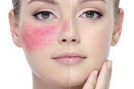 علاج حساسية الجلد والهرش للكبار
