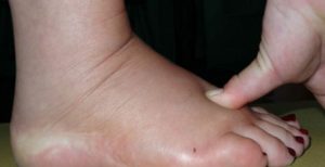علاج تورم القدمين عند كبار السن بالاعشاب