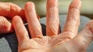 علاج أكزيما اليدين في المنزل